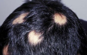 Types of Hair and Scalp problems - International Society